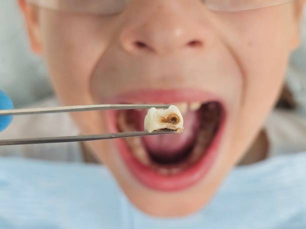 Best Dentist for Tooth Abscess  in Vergennes, VT