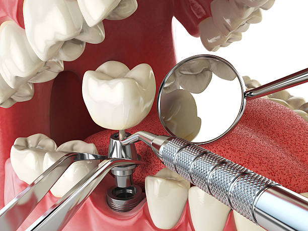 Best Chipped Tooth Repair Near Me  in Vergennes, VT